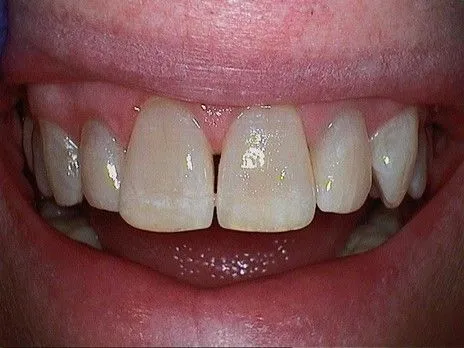 Before Veneers