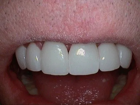 After Veneers