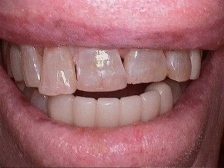 Before Veneers