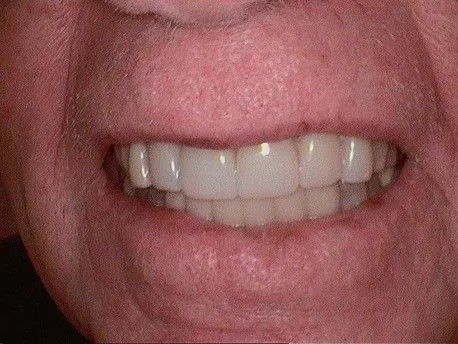 After Veneers