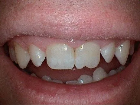 Before Veneers
