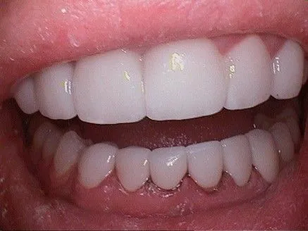 After Veneers
