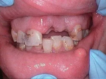 Before Veneers