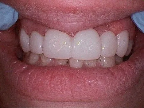 After Veneers