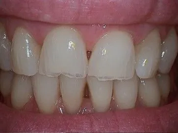 Before Veneers
