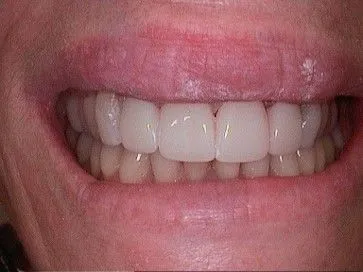 After Veneers