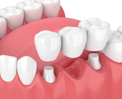 Dental Bridges