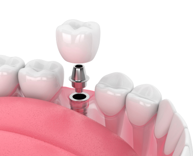 Dental Implants