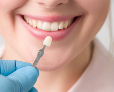 VENEERS